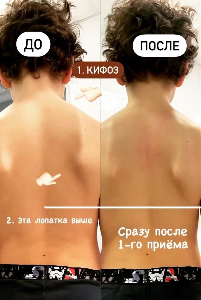 Сколиоз у детей