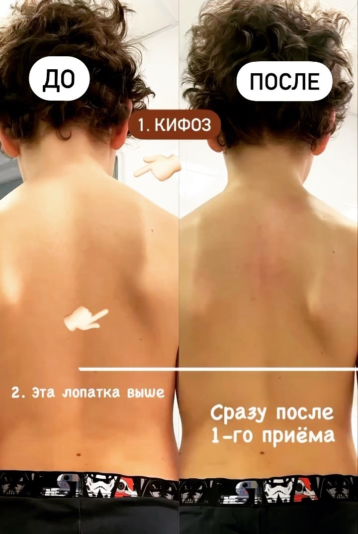 Сколиоз у детей